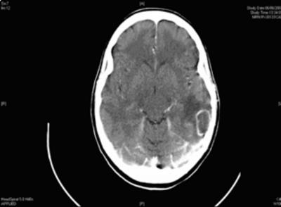 Contrast-enhanced CT scanning revealed left temporal ring enhancing lesions, and CT venography confirmed a filling defect in the left transverse sinus extending into the sigmoid sinus and jugular
