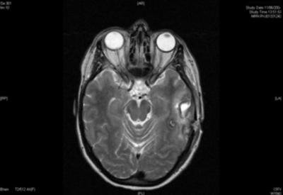 Figure 6 Figure 3: MR image. sequence MRI confirming the location of the ring-enhancing lesions and used for intra-operative neuro-navigation. Figure 7 Figure 4abc: MR imaging.