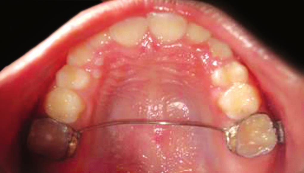 He presented with bilateral class I molar relation with permanent dentition. Treatment of cross bite was accomplished in two phases.