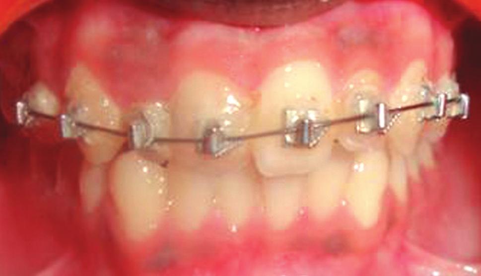 At 6-month review this retainer had been lost but the positive overbite had maintained the overjet correction.