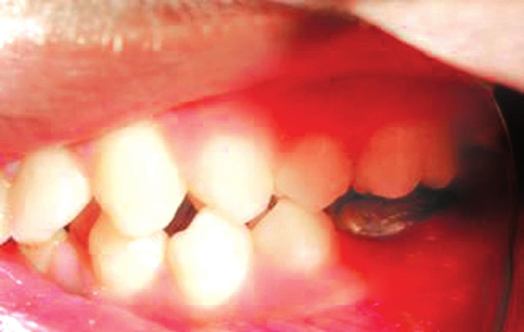 Rapid correction of malocclusion takes place in a single short phase of therapy. 2 4 offers a more effective and efficient tooth positioning 46 Fig.