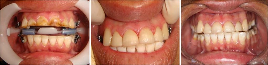 Santa-Rosa et al. BMC Oral Health 2014, 14:52 Page 4 of 8 Figure 1 Teeth with severe fluorosis treated with direct resin aesthetic veneers (baseline, after treatment, and follow-up).