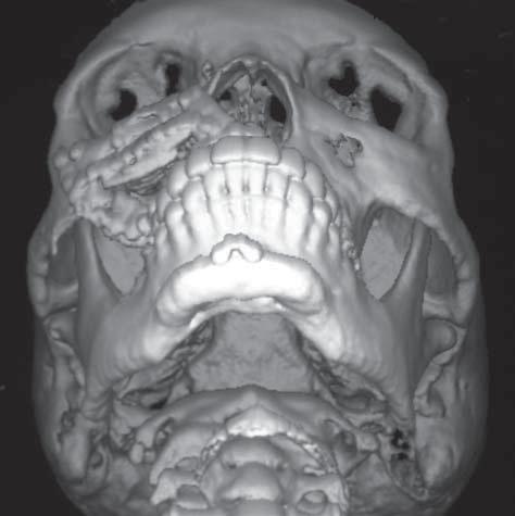 Postoperative 3-dimensional computed tomographic scan demonstrates adequate restoration of the right midface with positioning plates and bone grafts. Figure 10.