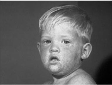 $100 Answer a. varicella b. measles c. hepatitis A d.