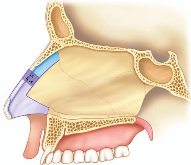 together. Fig. 6. An explanted tortuously deviated septum placed alongside a polydioxanone plate before the surgeon has cut the native septum into smaller workable pieces.