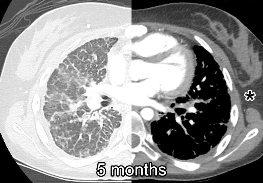 BLU-667 induced dramatic improvement in young PTC patient Baseline 23-year-old woman with PTC, sclerosing variant (CCDC6-RET fusion) who presented 6 years ago with symptomatic diffuse lung metastases