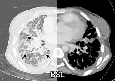 needs, pleural effusions and intubated 3 times over 6 wks) Initiated BLU-667 at 400 mg once daily RECIST SD (no target lesion/non-target lymphangitic lung metastases) Symptomatic response: O 2 weaned
