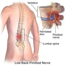 5 A pinched nerve caused by a bulging disc can also cause weakness in legs, stiffness and sciatica that travels from the buttocks all down the leg.