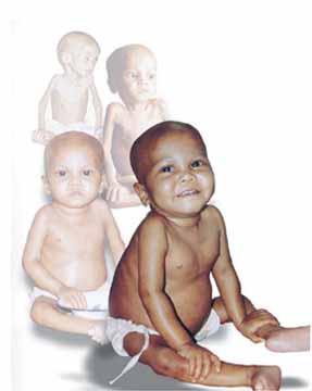 A case study at NRU of ICDDR B When Sheema s was 2 years old, admitted Dhaka hospital of icddr,b suffering from profound malnutrition, pneumonia, and