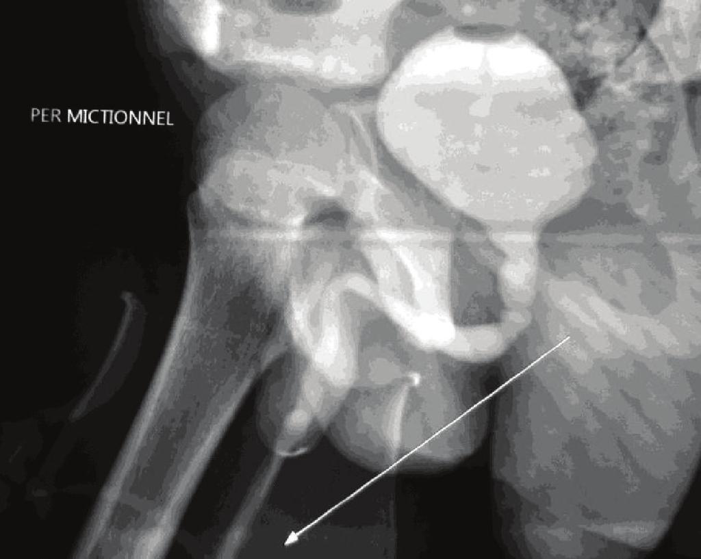 2 Case Reports in Urology Figure 1: Stricture of the bulbous urethra as shown on the miction cystourethrogram (Case 1). during the neonatal period without any complications.
