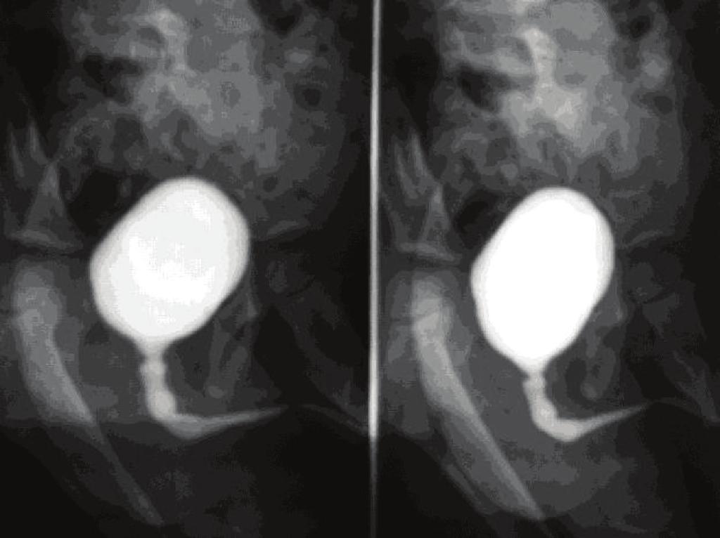 urethra. The stricture area was dilated using the endoscope and a hinge 12 Foley catheter was left indwelling for 8 days.