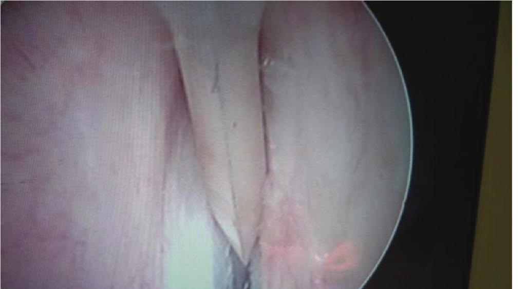 4 Case Reports in Urology Figure 5: Endoscopic view of an inflammatory urethra (Case 3).