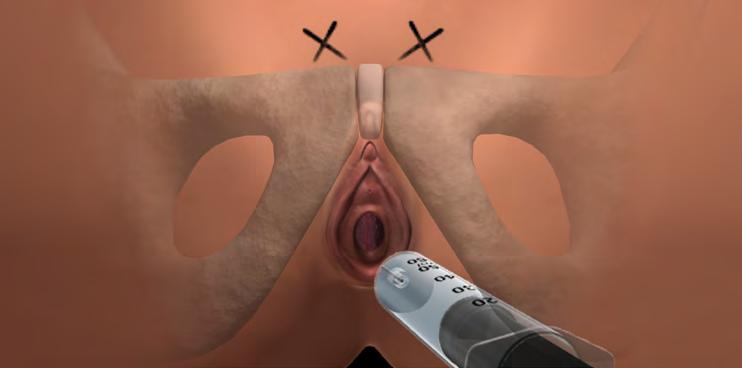 Patient Prep Steps 1-4 STEP 1: Mark the exit points and inject suburethral local anesthesia Place patient in dorsal lithotomy avoiding hip flexion greater than 60º Insert 18 French Foley catheter and