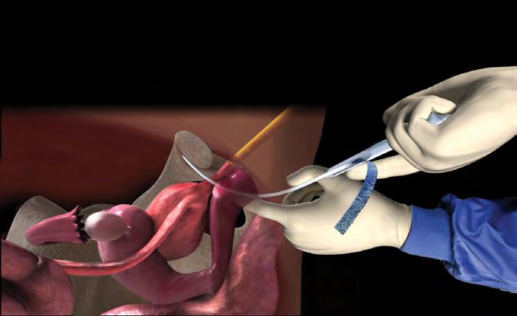 paraurethral dissected space Pass the Tip of the Trocar Sheath until it reaches the end of the dissected space STEP 6: Perforate urogenital diaphragm During perforation of the urogenital diaphragm,
