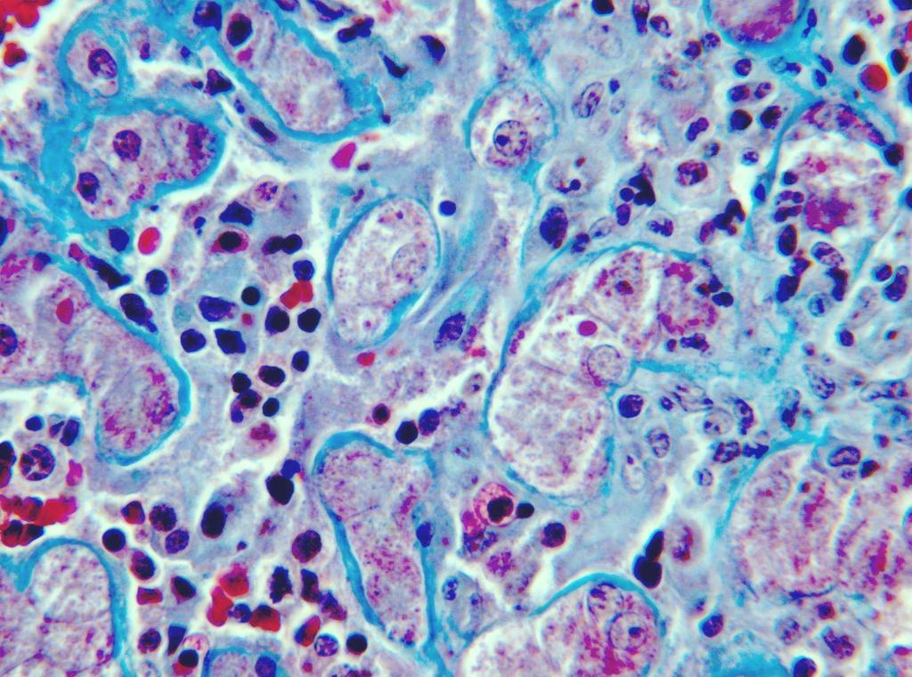 Liver: Sinusoidal fibrosis associated with extramedullary hematopoiesis H H H H H H H H H