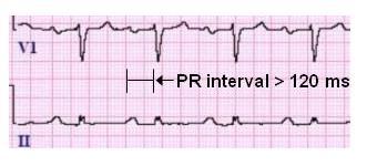 PR Interval The time from the beginning of the P wave, indicating atrial depolarization, to the beginning of the QRS