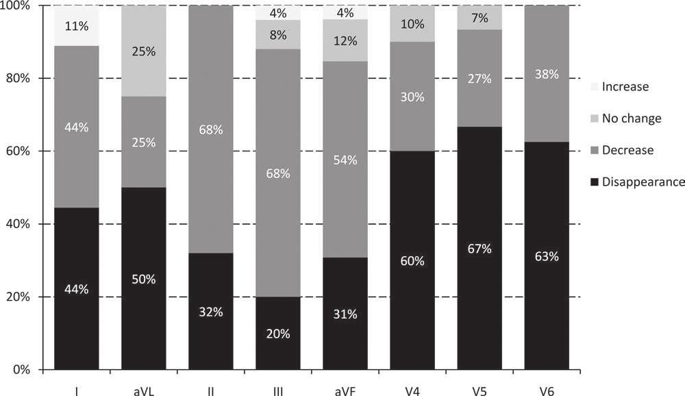 ajmaline challenge, the rate of complete disappearance of J waves varied according to regions: 28% in the inferior leads (II, III, and avf), 46% in the high lateral leads (I and avl), and 63% in the
