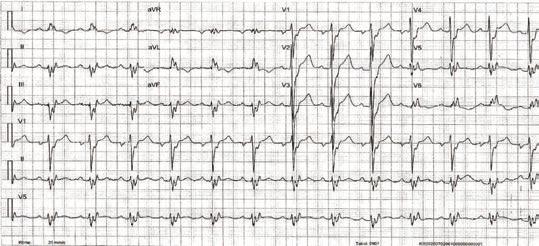 ECG findings indicating poor prognosis in LBBB 1.! QRS width: the wider the worse! 2.