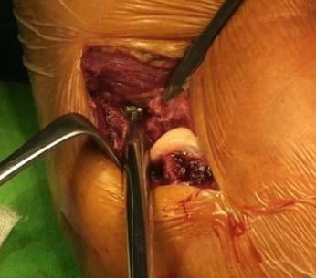 4. Preparation of the implant s location: The opening and rasping process of the intramedullary canal