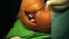 8. Closing of the surgical incision: If it shows luxation tendency, control it after the lig.anulare suture.