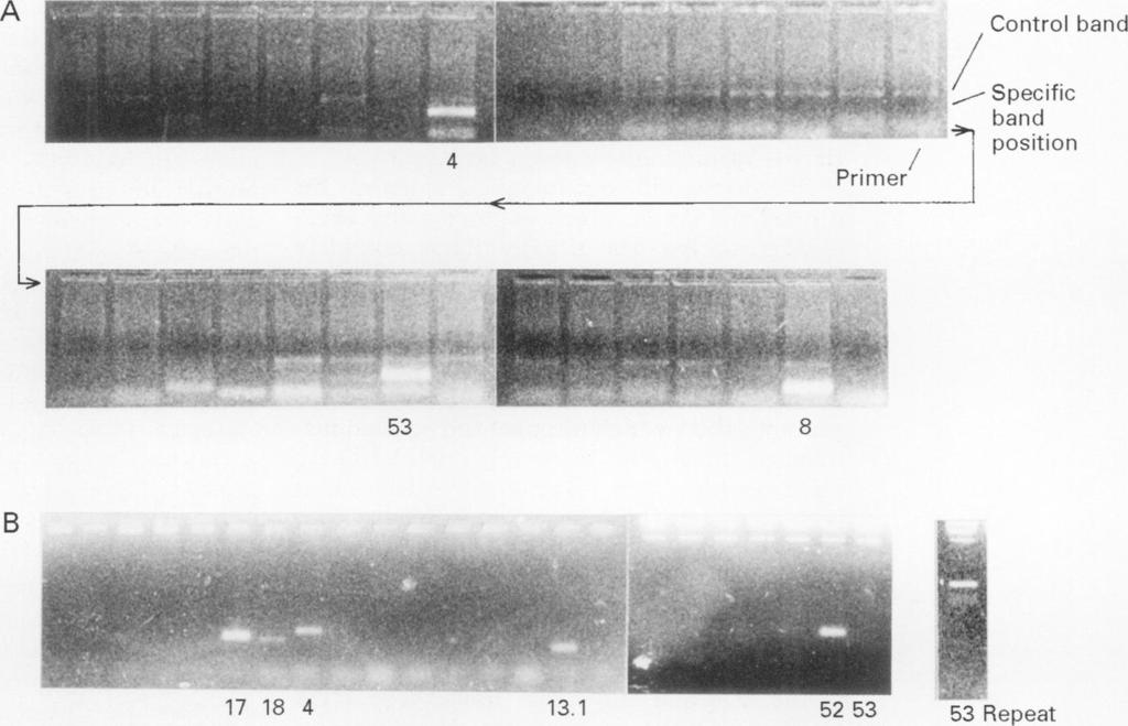 Genetic analysis of hydatidiform moles using PCR HLA typing A 291 Conitrol band B l 53 17 18 4 13.1 4 8 5.