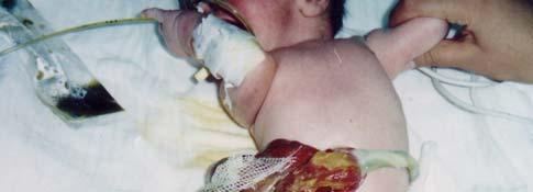 Congenital anomalies including GS have been increased in frequency in upper Egypt during the last two decades 2,3.