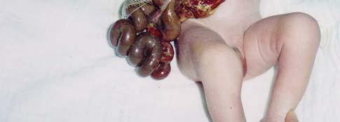 Fig 1: Fig 1: Gastroschisis with thickened oedematous bowel.