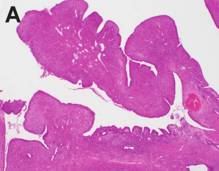 2 Case Reports in Obstetrics and Gynecology (a) Figure 1: (a) Tumor cells with two components: endocervical glandular lesion without atypia of a phyllodes-like pattern and periglandular, spindle