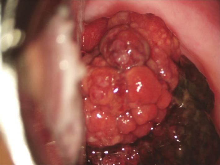 Tumor markers such as CA125, CA19-9, and CEA were all within normal ranges. Then, she underwent conization of the uterine cervix to confirm the existence of a residual lesion.