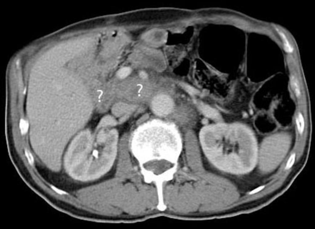 Fig. 7: CT examination of 59-years old patient, 18 months