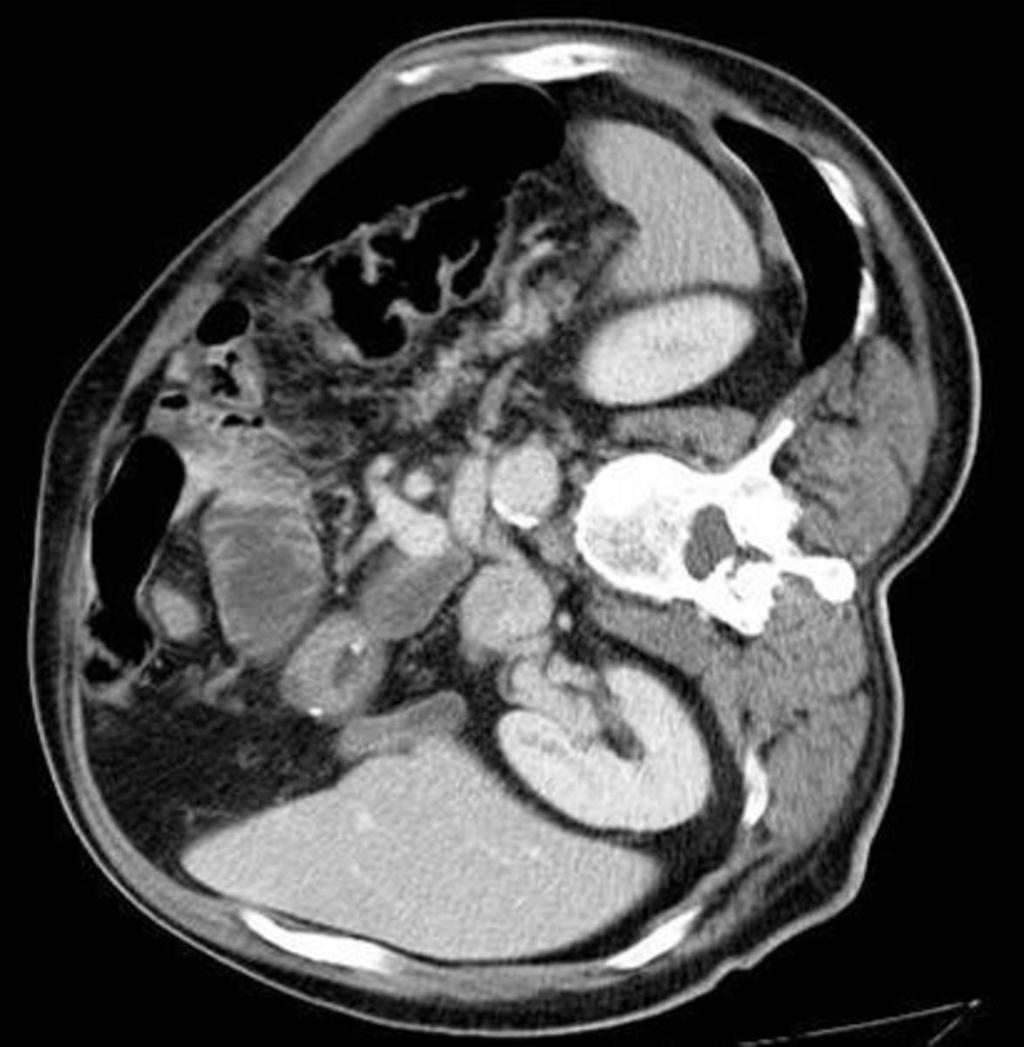 Fig. 5: CT examination of 53-years old patient 2 years