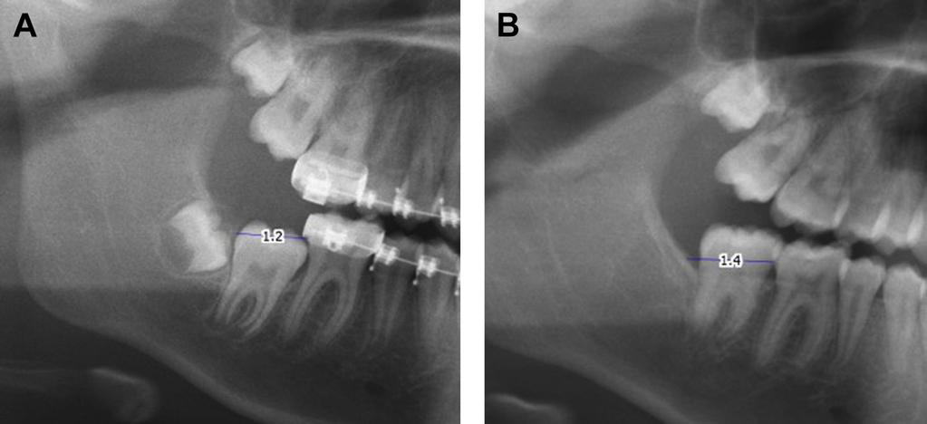 PADWA, DANG, AND RESNICK 1583 concomitant extraction of the adjacent third molar.
