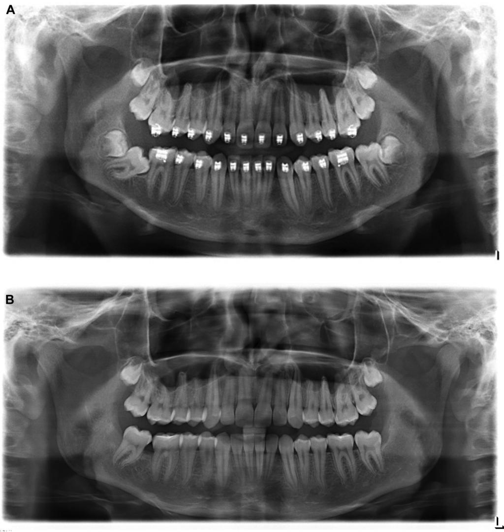 PADWA, DANG, AND RESNICK 1585 FIGURE 3. A, Preoperative and B, postoperative panoramic radiographs of a successfully uprighted mandibular right second molar.