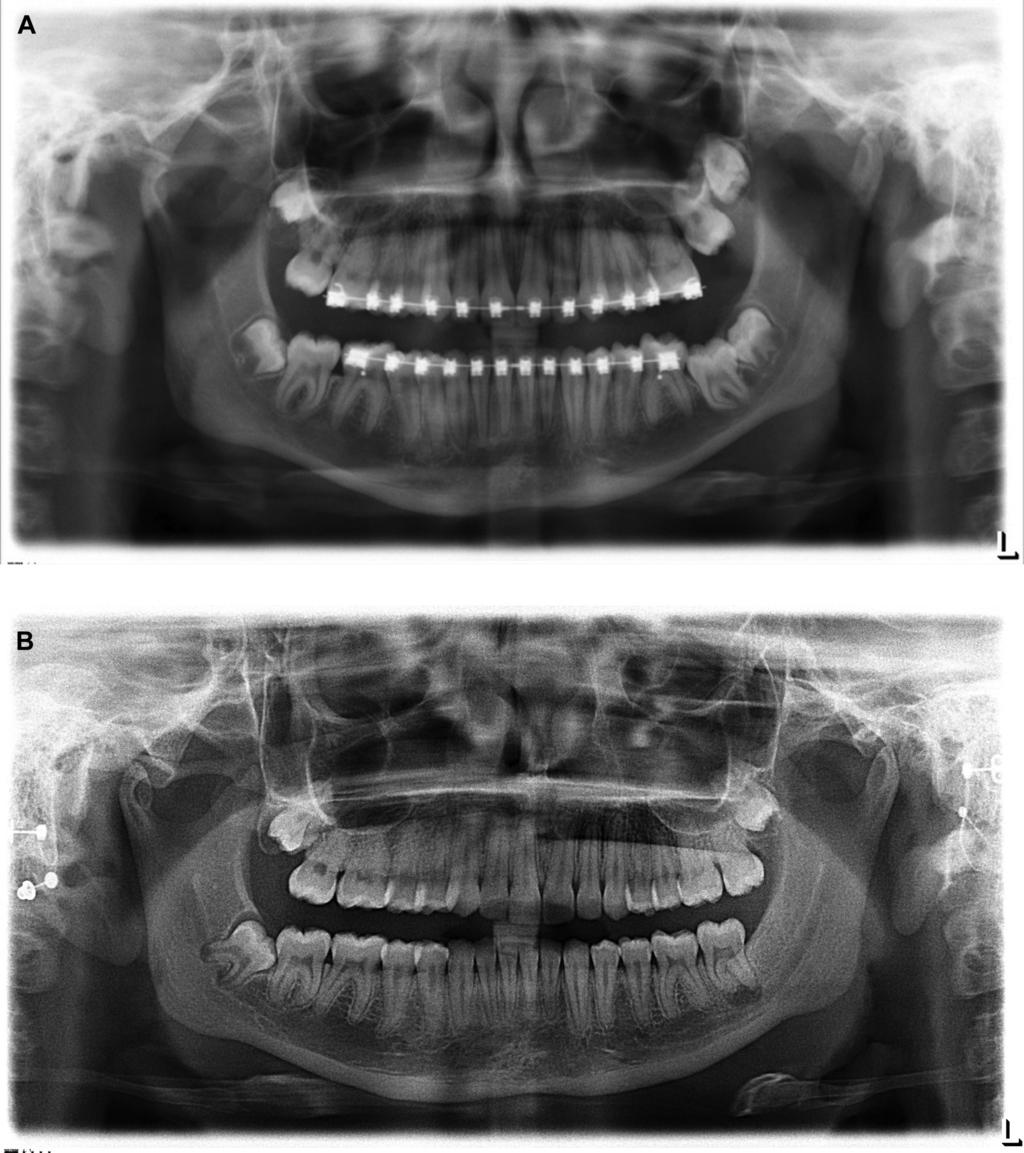 PADWA, DANG, AND RESNICK 1587 FIGURE 5. A, The impacted left mandibular second molar showed B, asymptomatic periapical radiolucency after surgical uprighting.