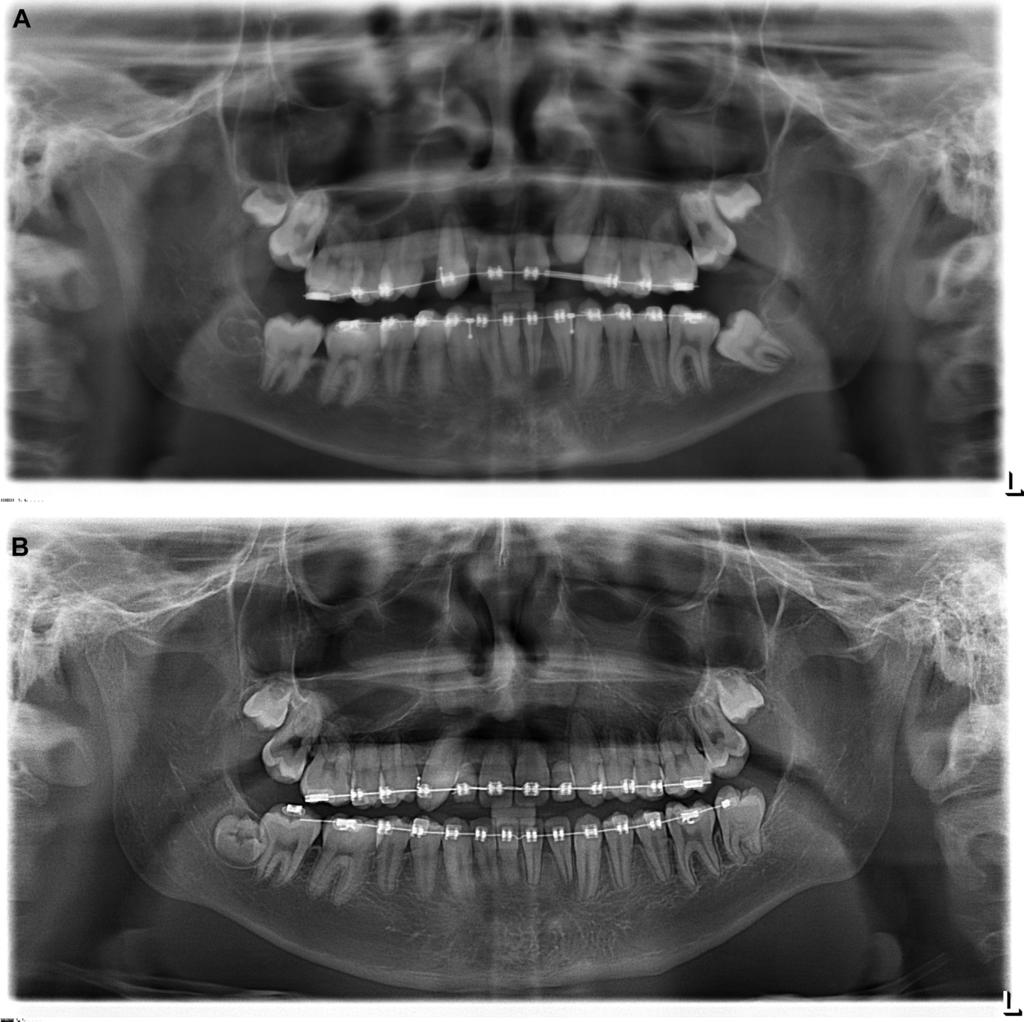 1588 SURGICAL UPRIGHTING OF IMPACTED SECOND MOLARS FIGURE 6. A, The impacted left mandibular second molar showed B, asymptomatic root resorption after surgical uprighting.