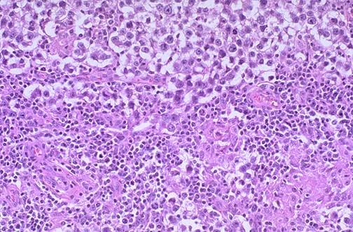 Microscopy - embryonal carcinoma and seminoma Fig. 3. The macroscopic appearance of the tumor The diagnosis was positive for pt2nxmx Mixed germ cell tumor.