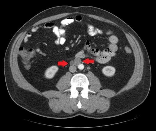 Asymptomatic complex testicular neoplasia associated with orchiepididymitis. Case report After six weeks postoperatively, although the AFP reached normal blood levels (3.