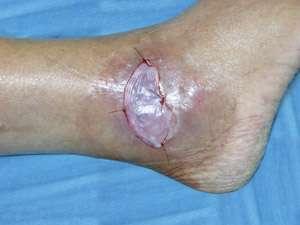 APLIGRAF: APPLICATION Adequate wound bed preparation good granulation