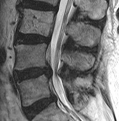 Reason for revision In previous reports, disc herniation is the first or second