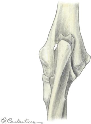 The cranial crura of both ligaments attach to the radius, whereas the caudal crura attach to the ulna. They are considered thickenings of the fibrous joint capsule.