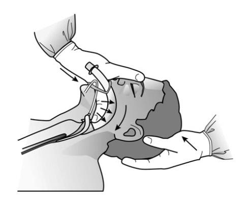 In order to ensure airway is completely deflated, the flip-test should be performed. When the tip of the deflated cuff is inverted, it should flip back to its original position.