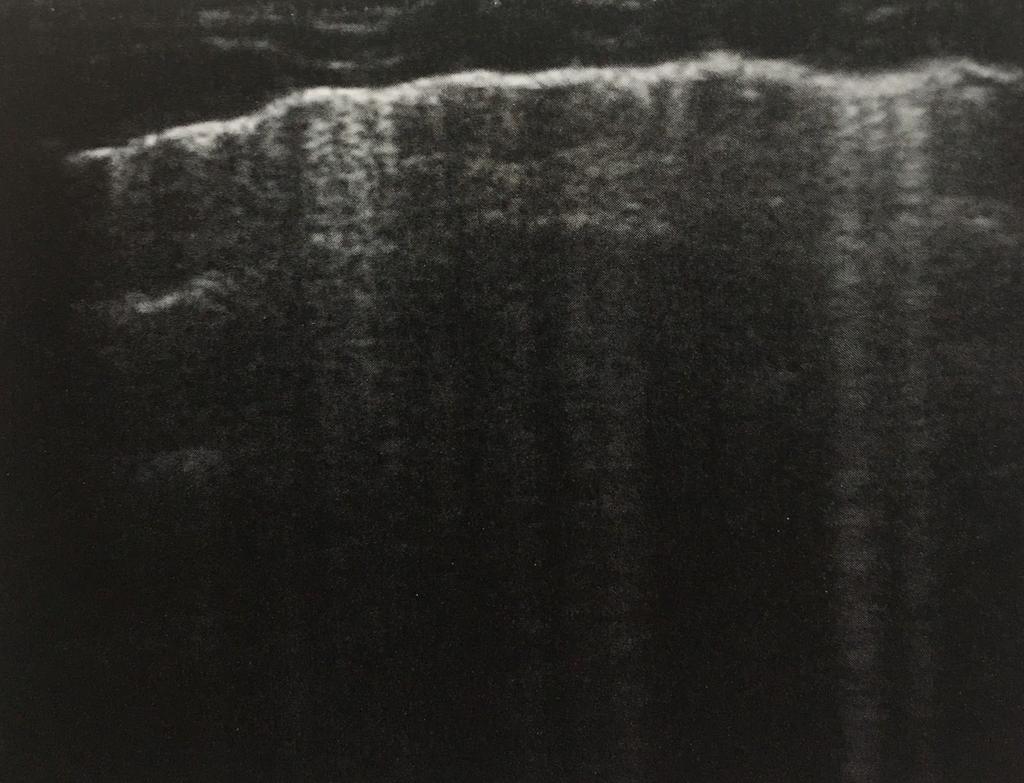 pleural line that is best seen when perpendicularly scanned Generated by the presence of air (normal or pathologic) B-lines This is a type of reverberation artifact, most specifically a ring down
