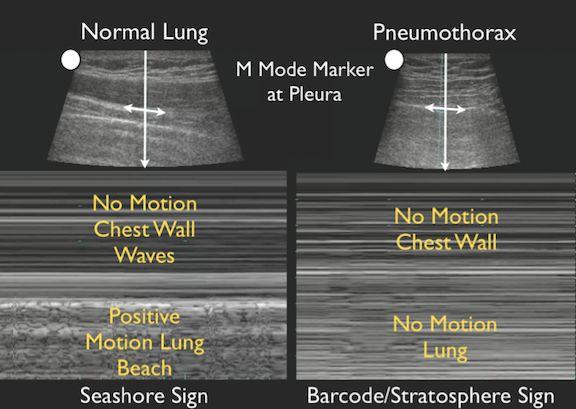 M-mode essentially is reflection artifact deep to the pleural line.
