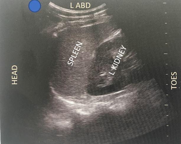 Spleno-renal (LUQ) Orient transducer longitudinally (coronally) and cephalad (towards head) on the left flank. Note that the left kidney is more superior-posterior than the right kidney.