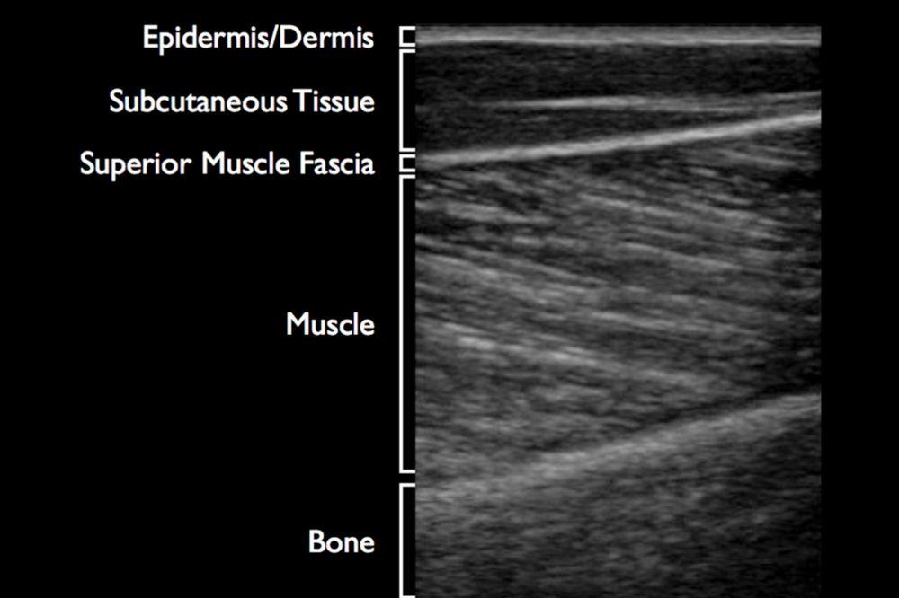 com/soft-tissue- 5-min-vid-2/ Soft Tissues Hyperechoic line shows the bone at the bottom of the picture, striae of the muscle