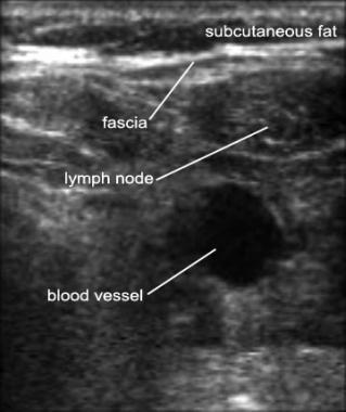 Lymph Node Lymph node can present like an abscess, but will show blood flow