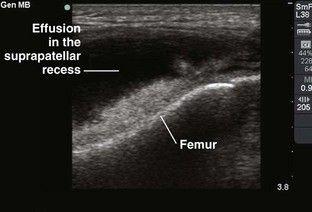 indicative of a knee effusion.