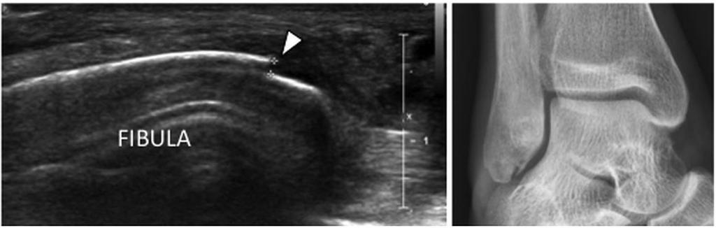 Fracture Longitudinal AND transverse images should always be obtained.