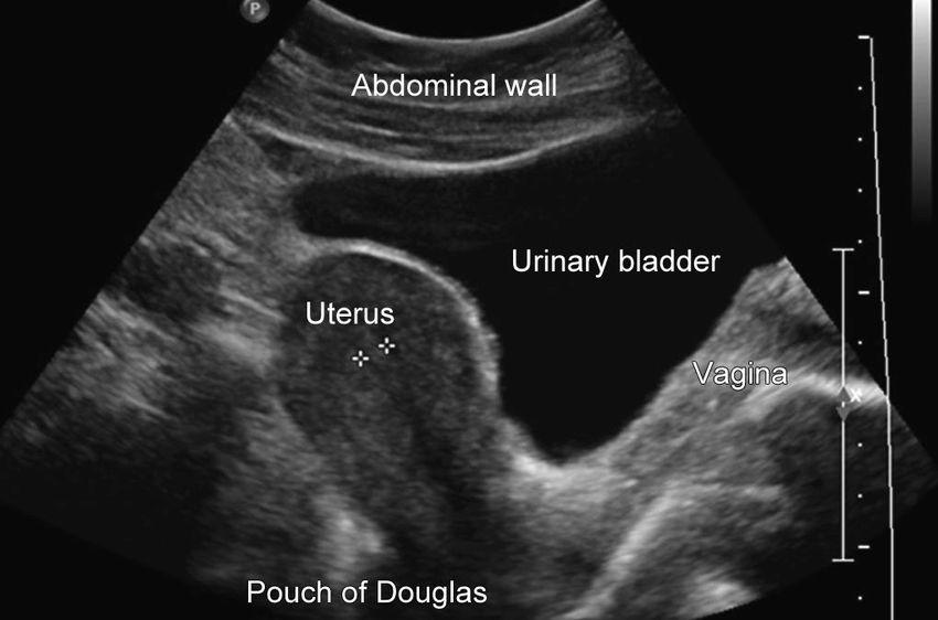 Transabdominal SAGITTAL View Bladder appears as a wedge Uterus appears Left of the