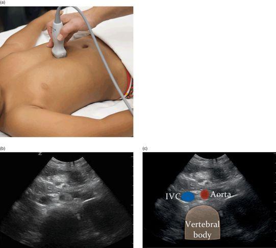 Patient Positioning should be in the supine position. Gentle pressure may be applied to displace bowel gas which can obstruct the view of the IVC.